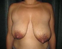 Before breast reduction