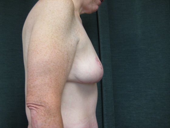 After breast lift